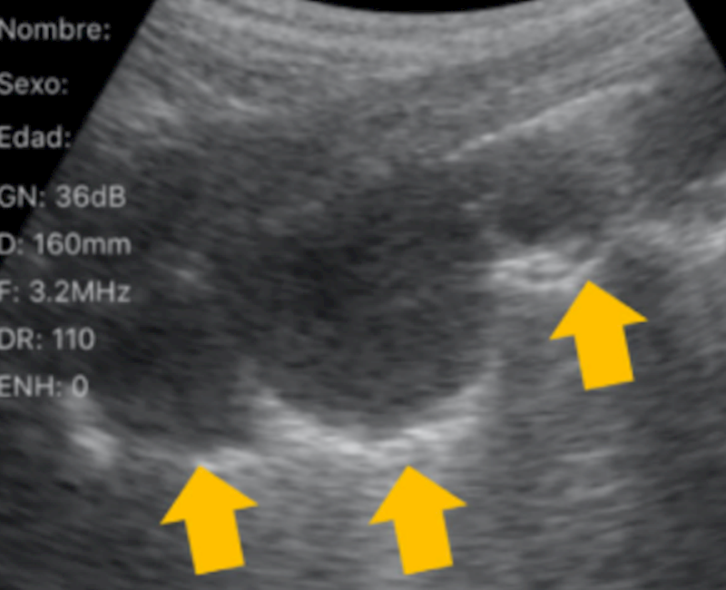 Metastatic testicular cancer presenting with dyspnoea: A case report on the utility of lung ultrasound in the emergency department